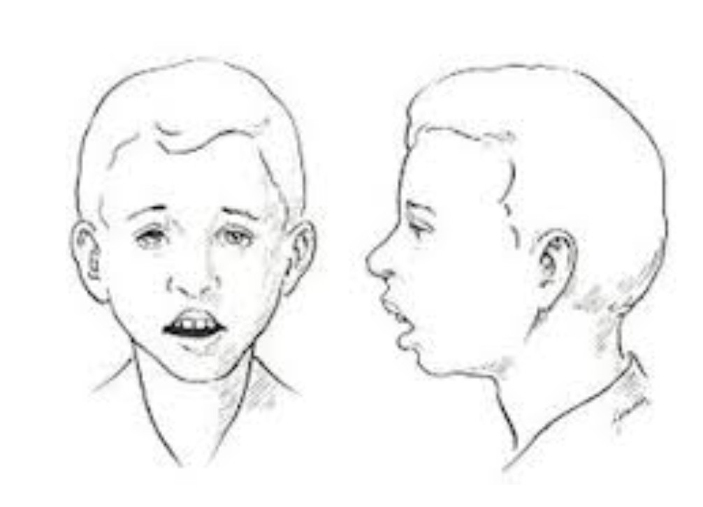 Imagen de un niño con apariencia facial facies adenoidea.