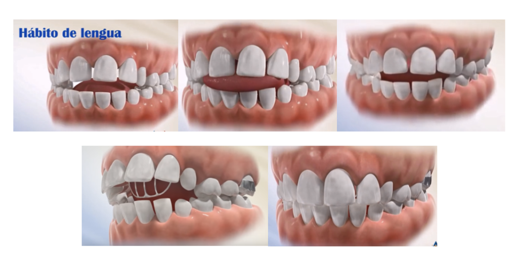 Imagen representativa de como es el hábito de la lengua