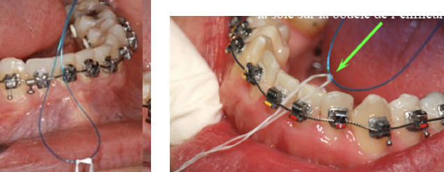 Indicaciones visuales de cómo usar el hilo dental llevando ortodoncia