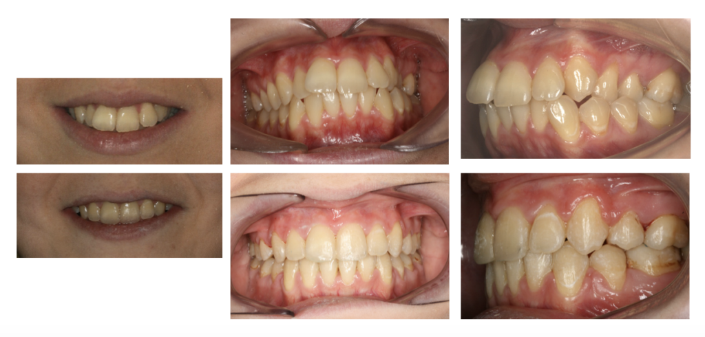 imagen. Apiñamiento dental. del antes y el después de cómo cambió su sonrisa gracias al tratamiento.